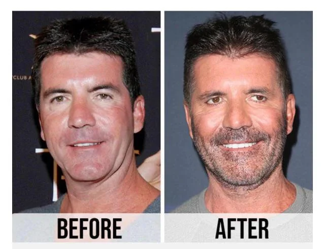 Simon Cowell Plastic Surgery Before and After 2024